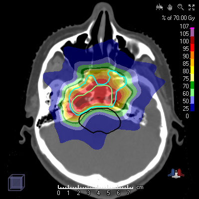 Proton treatment plan to irradiate the tumor (green, light blue) with high dose while sparing the healthy brainstem (black).en Hirnstammes (schwarz).